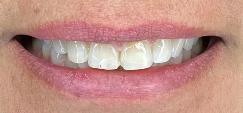 Caso clínico — antes del diseño de sonrisa con resina (Dra. Gabriela Estrada, CDMX)