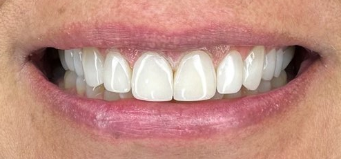 Caso clínico — después del diseño de sonrisa con resina (Dra. Gabriela Estrada, CDMX)