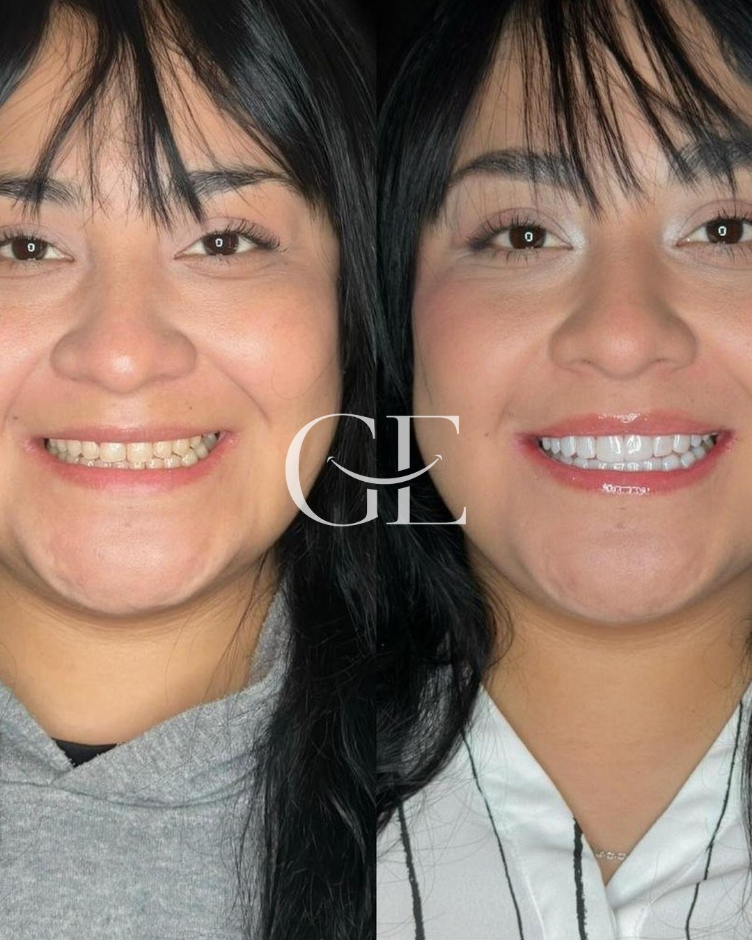 Antes y después de diseño de sonrisa