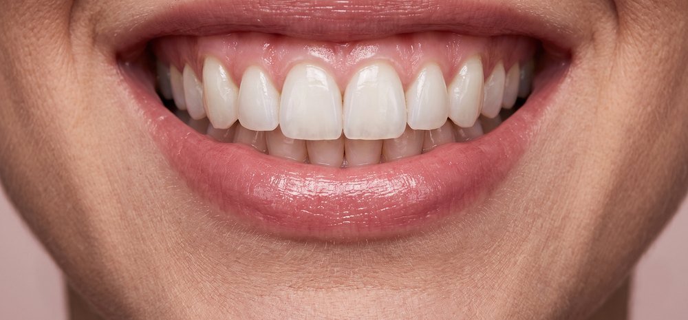 Sonrisa con carillas de resina, dientes naturales con translucidez
